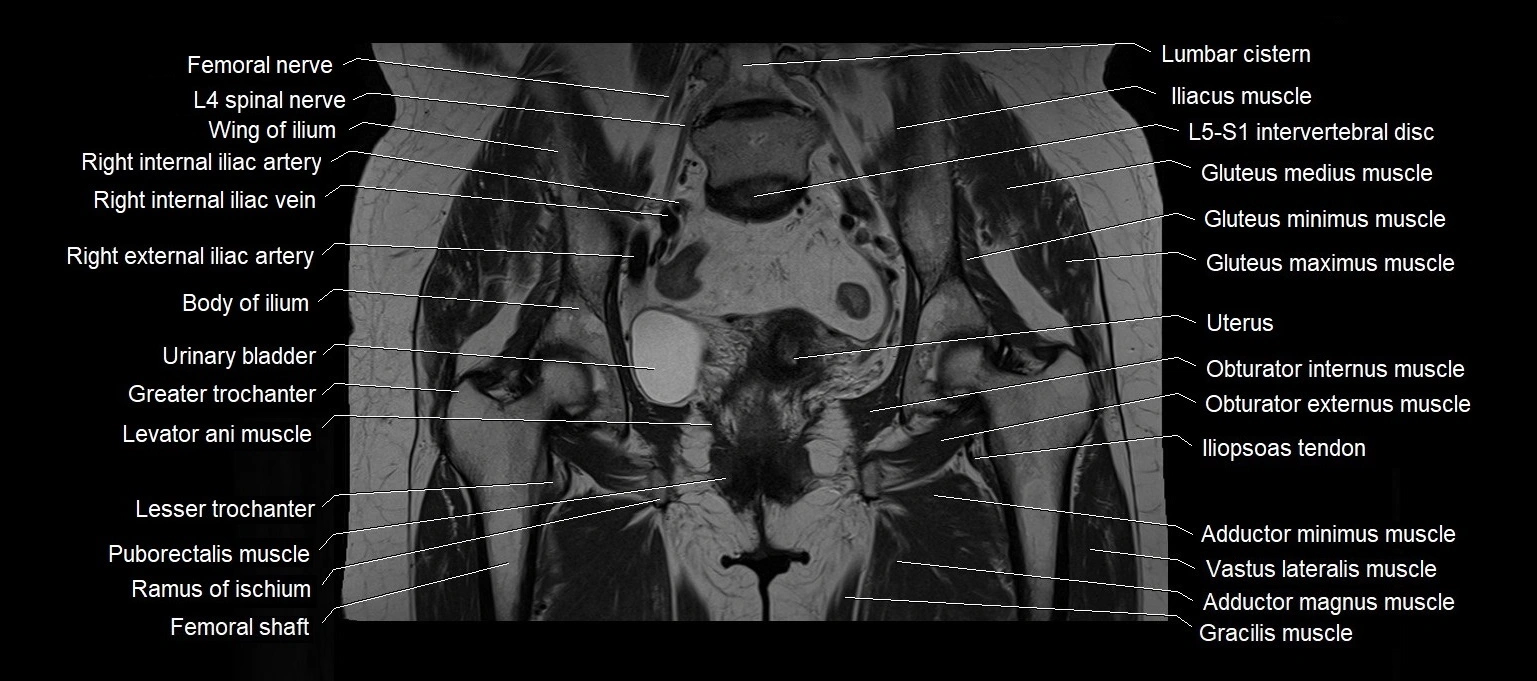 MRI 3T pelvis coronal cross section anatomy image 15.webp